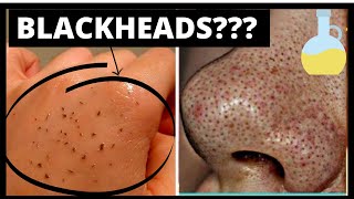 oil cleansing for whiteheads