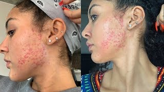 Facial Gone WRONG!!