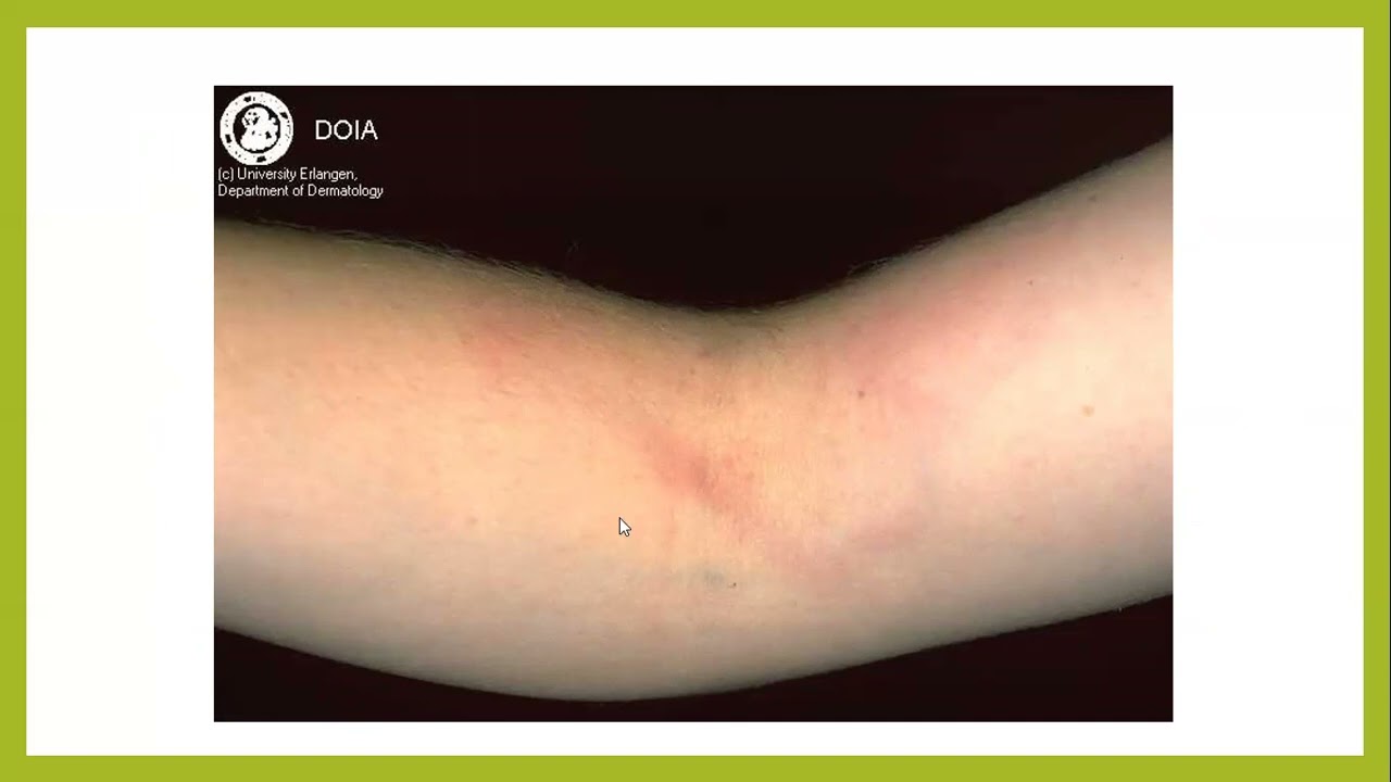 Lecture-162: Disorders of Lymphatic vessels. Part III. Rook's Chapter 105.