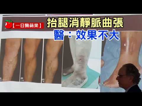 【一日醫蘋果】抬腿消靜脈曲張　醫：效果不大 | 台灣蘋果日報