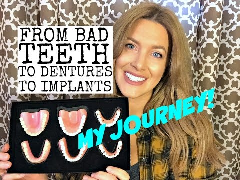 Bad teeth, dentures, and dental implants: My Story