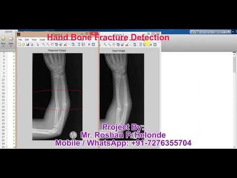 Matlab Code for Hand Bone Fracture Detection using Image Processing