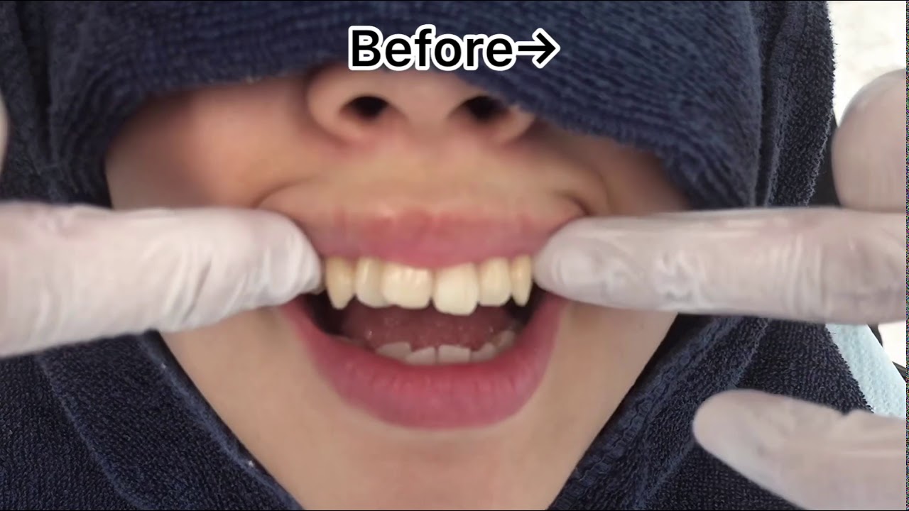 ☆1day スピードセラミック6本☆ 前歯の歯並びをまずは仮歯で整えます