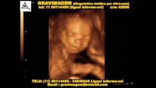 Gravimagem 11737 Ultrom 3D 4D Obstétrico E Morfológico Em Gravidez Com 24 Semanas