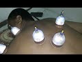 How to perform Hijama. The Cupping therapy. Sunnat bhi Elaaj bhi.