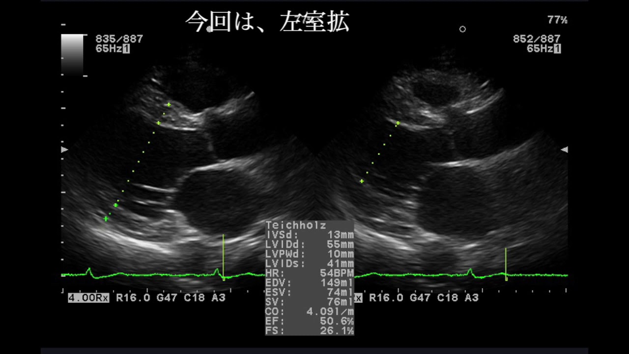 HCMの原因は何ですか?