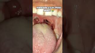 pendarahan pada bekas operasi amandel #bleeding #pendarahan #amandel #tonsil