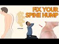 Back hump exercises and posture fix  kyphosistreatment toronto