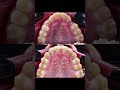 صنف ثالث مع عضة حد لحد مع ناب منطمر Breakingnews Invisalign تجميلاسنان Smile 