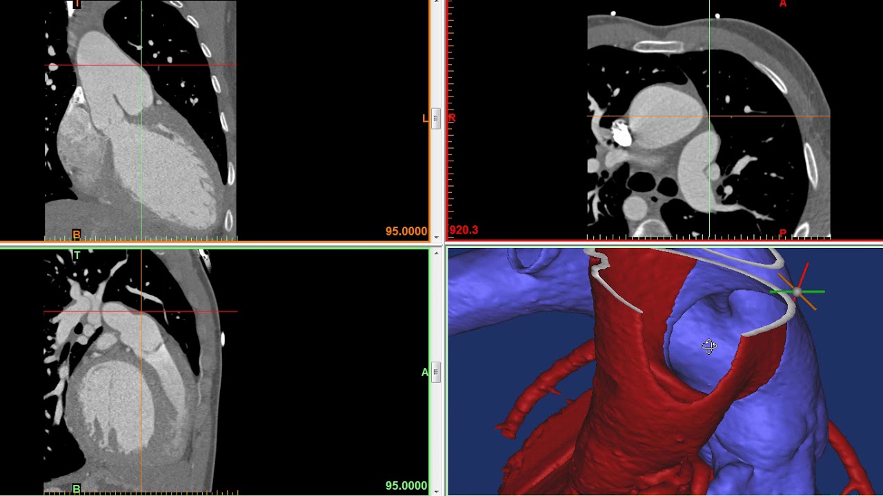 Case 3 AortoPulmonary Window YouTube