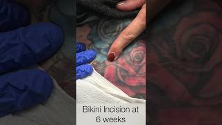 6 Week Follow Up Doing Great MAKO Bikini Incision Direct Anterior Hip Replacement | Dr. Robert Cagle