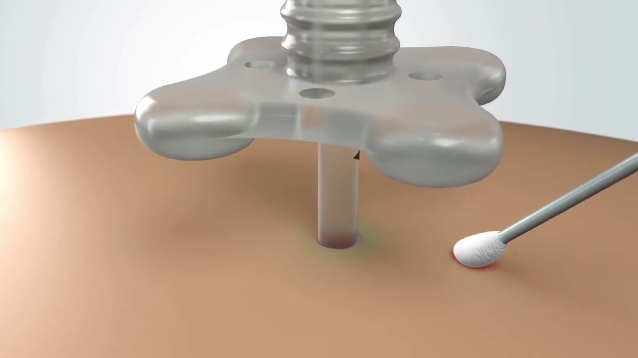 MIC PEG Tube Maintenance and Stoma Care