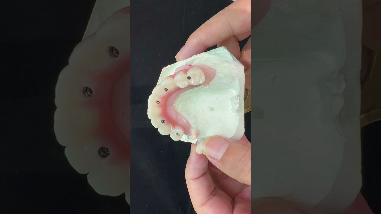 Titanium Implant Supported Dentures Precise Ivoclar Denture Over Implants