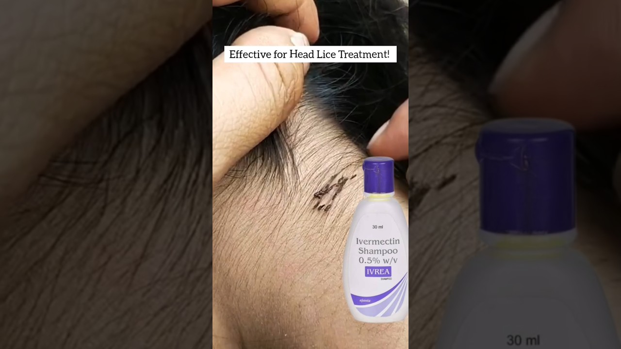 Lice & nits removal Home remedy 