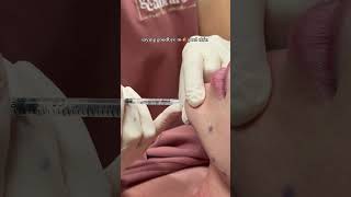 How Botox Fixes Orange Peel Chin | Quick Treatment Explained ✨