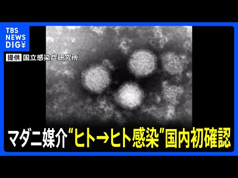 患者→医師への“ヒト→ヒト感染”国内初確認　マダニ感染症「SFTS」国立感染症研究所は注意呼びかけ｜TBS NEWS DIG