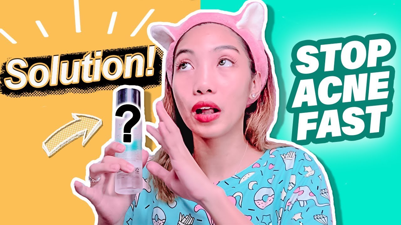 How to Cure Acne Fast and Effectively ( SOLUSYON SA ACNE ) Luxe Organix Miracle Toner Full Review