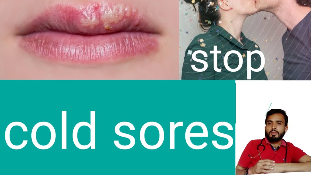 COLD SORES //ORAL HERPES //CAUSE ,SINGS ,SYMPTOM , BEST TREATMENT . YouTube