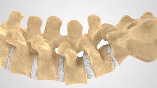 MAS Fixation Patient Education Animation US