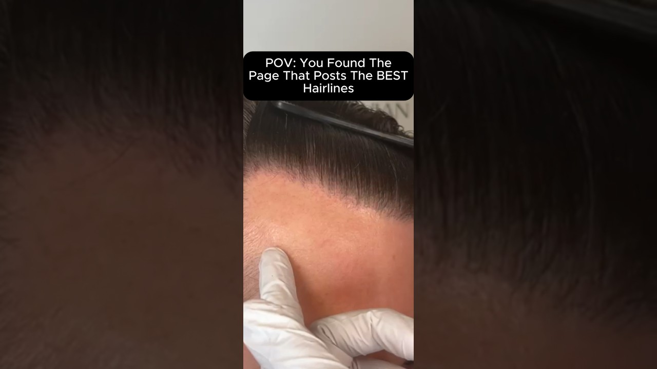 Rate This New Hairline 1-10 👀🔥