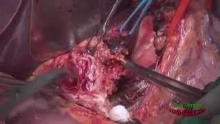 видео Абдоминальная хирургия. Понятие