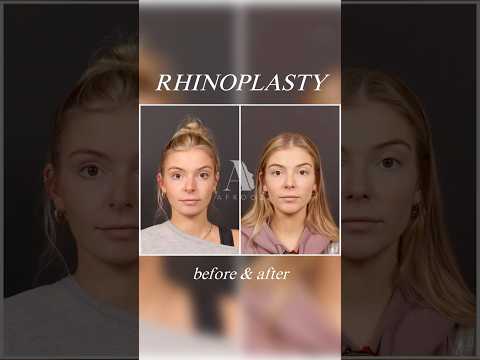 Video thumbnail: Stunning Rhinoplasty Transformation · Paul N. Afrooz, MD