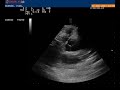 9 PIEC arteria pulmonar y bifurcacion insu