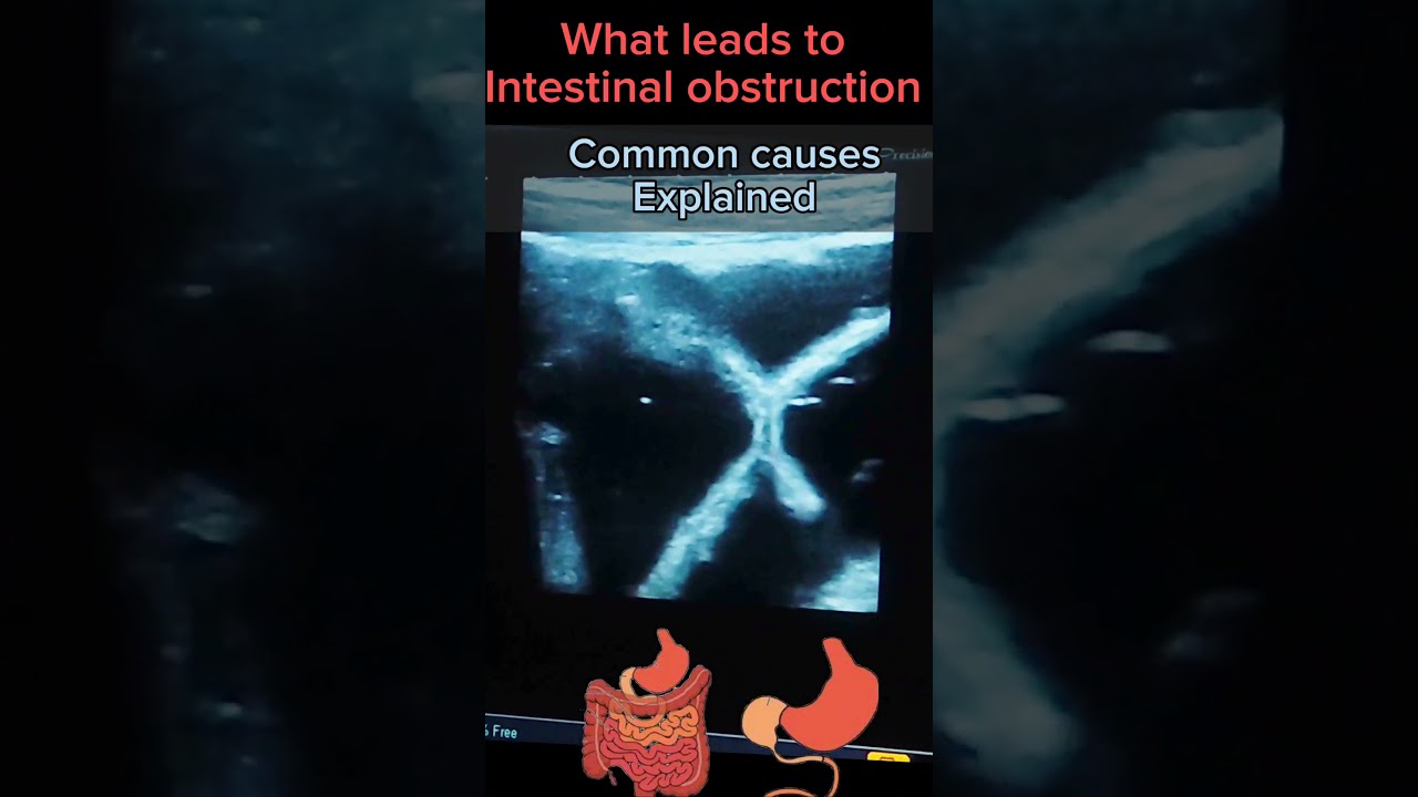 What Leads to Intestinal Obstruction 