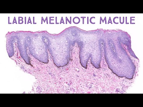 Video: Hvad er oral melanotisk macule?