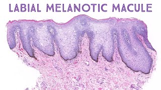 Labial melanotic macule (brown spot on lip) (Stony Brook Case 1) dermatology dermatopathology