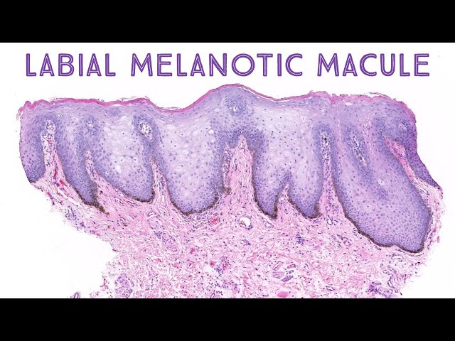 volar melanotic macules A cross-sectional study of physiologic volar melanotic macules:  Demographic, historical, clinical, and dermatoscopic features of a common  yet neglected pigmentary variant in individuals with skin of color