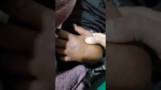 مريضة وصلت  مع generalized body odema مع تورم اوردة الرقبة  وصعوبة تنفس ايش ال most likely diagnosis