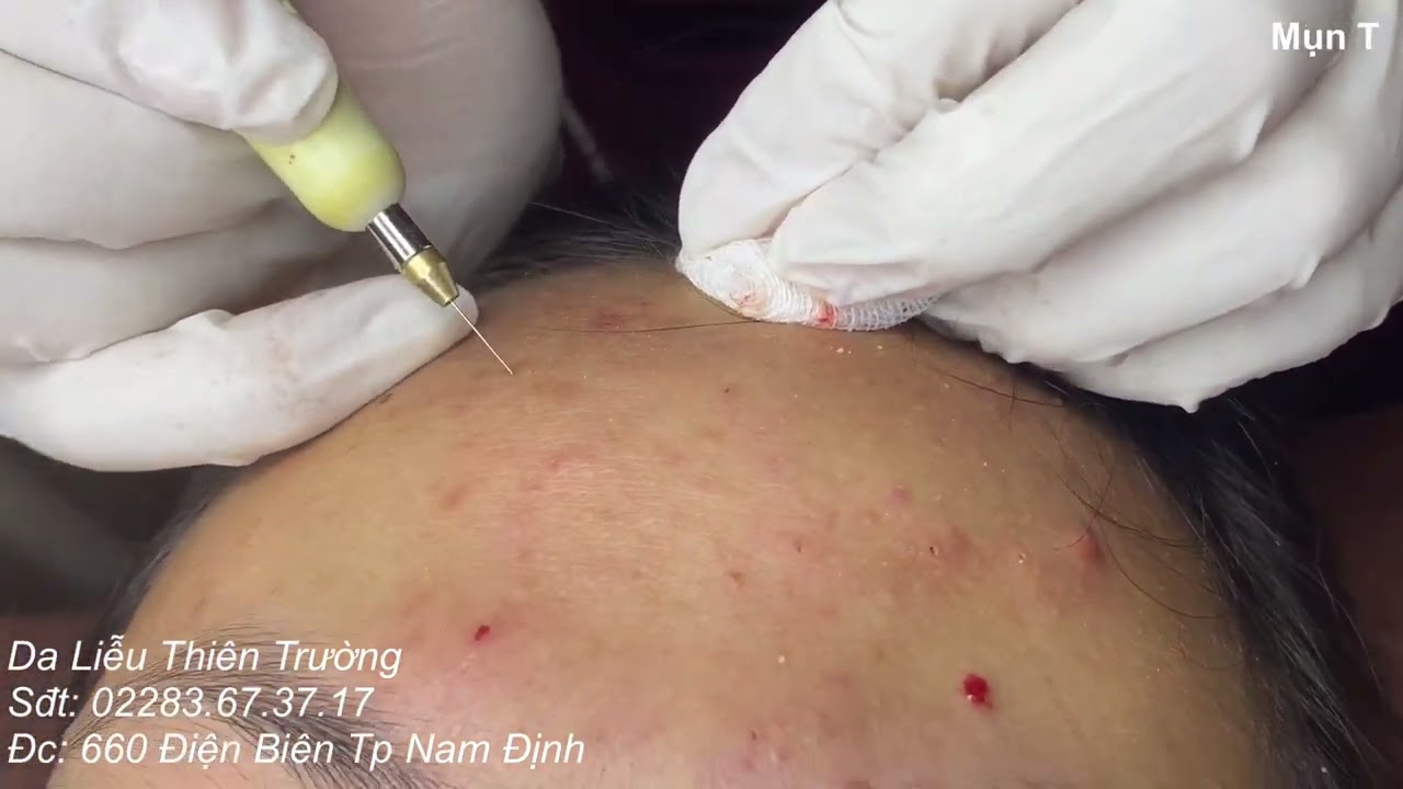 Điều trị mụn chuẩn y khoa - youtube