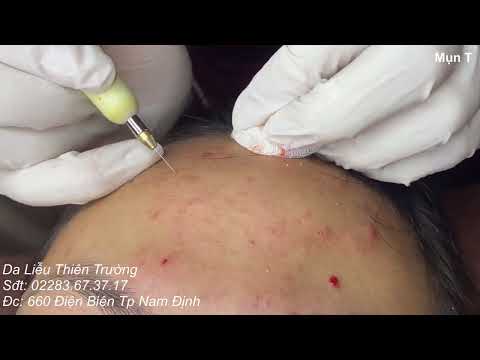 Video Điều trị mụn chuẩn y khoa - youtube