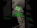 Most Common Symptoms of Atlas (C1) Misalignment | Upper Cervical Care