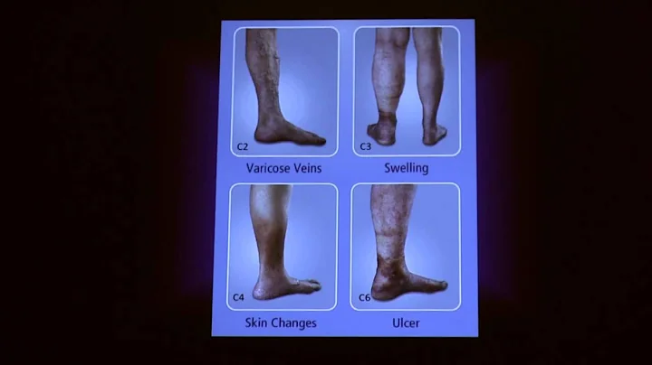 Treatment Options for Superficial Venous Disease |...