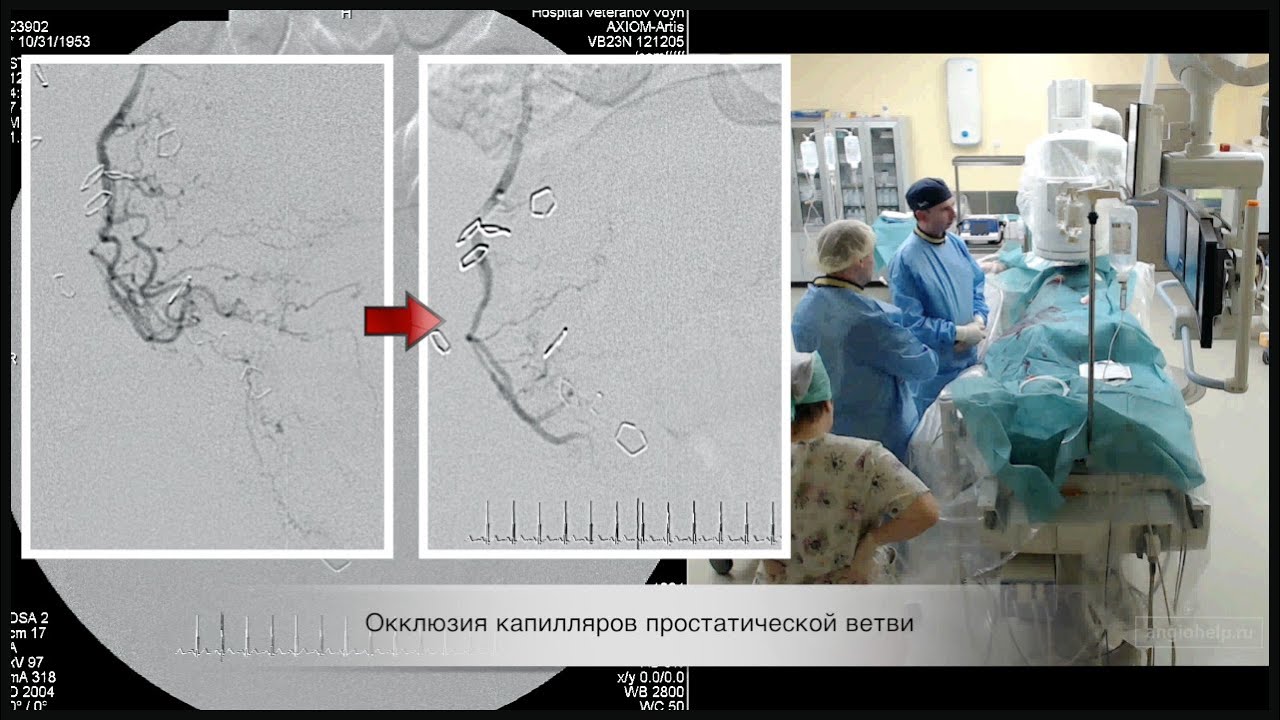 Артерии простаты. Эмболизация предстательной железы. Эмболизация простатических артерий. Эмболизация аденомы простаты. Эмболизация артерий предстательной железы.
