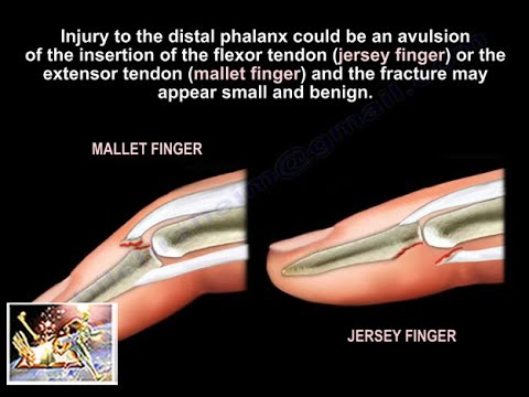 Extracto domingo personal Mallet and Jersey Fingers Description- Everything You Need To Know - Dr.  Nabil Ebraheim - YouTube