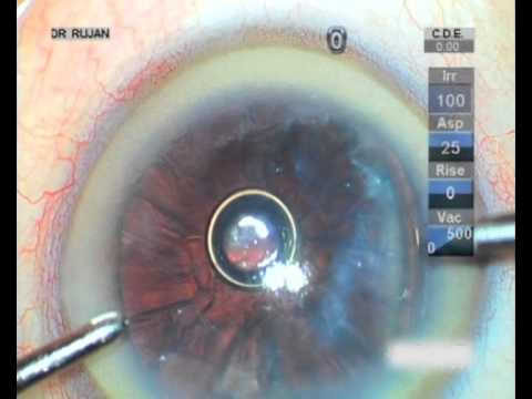 Operatie cataracta dr. Rujan (Oradea)