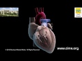 Aortic Valve Replacement (Hindi) - CIMS Hospital