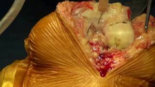 Live Surgery of Total Knee Replacement by Dr Amit Bhutani (720p HD)