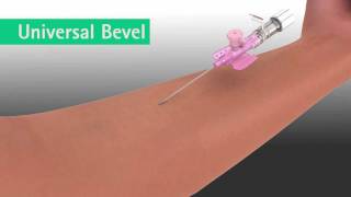 Vasofix® Safety(The animation of the B.Braun Vasofix® Safety IV Catheter provides a quick insight into the main product features. It describes the details, purposes and benefits ..., 2011-08-03T06:30:54.000Z)