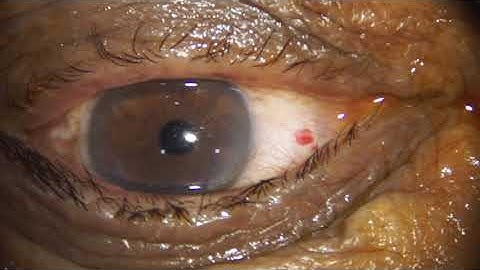 Ozurdex (Allergan) Intravitreal Implant | Retina Injection | Dr Madhusudan Davda