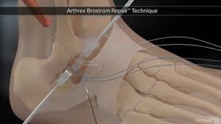 KĨ THUẬT BROSTROM TRONG ĐIỀU TRỊ MẤT VỮNG CỔ CHÂN screenshot 3