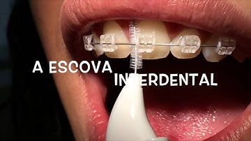 Higienização Usando Aparelho Ortodôntico Fixo