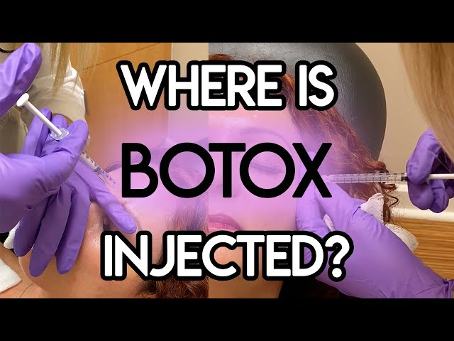 Where is Botox Injected?