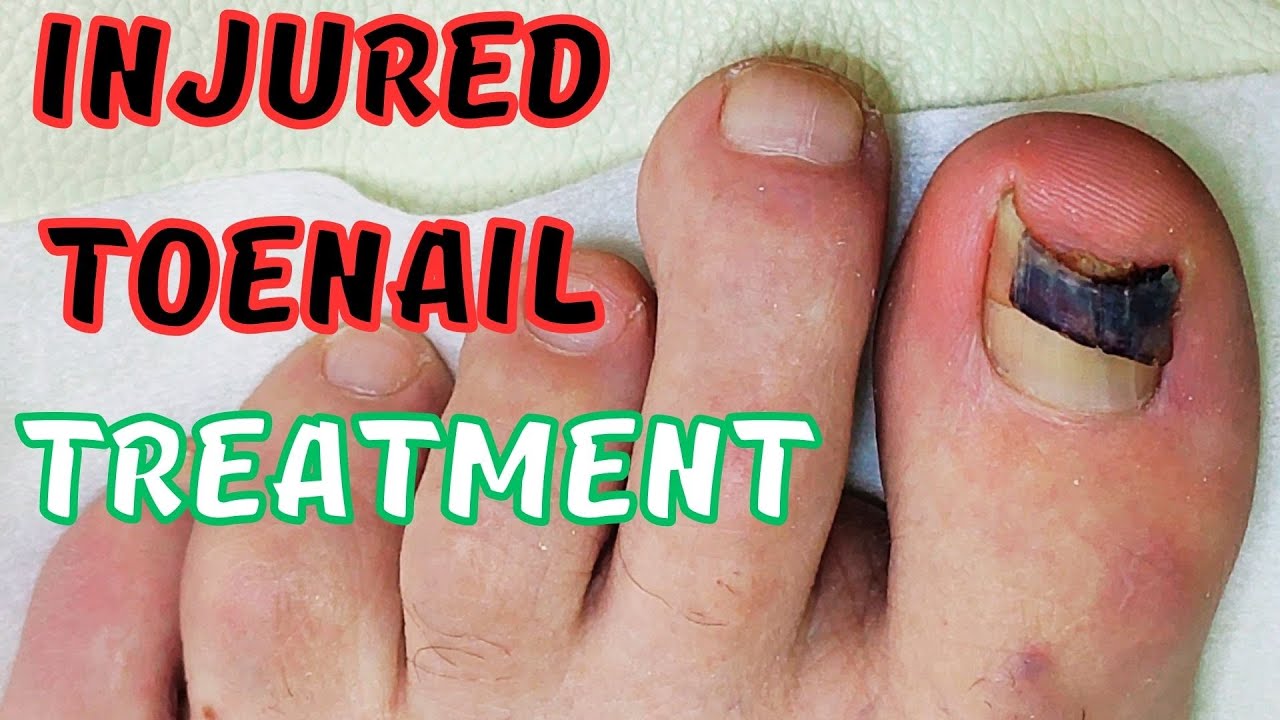 Injured toenail treatment. Fungus. YouTube
