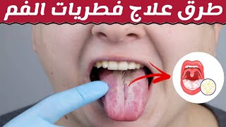 فطريات الفم او كانديدا الفم اسبابها و طرق علاجها | Oral thrush