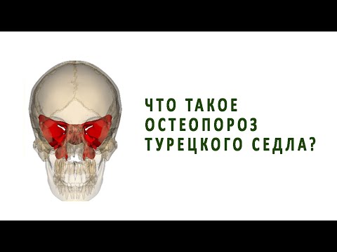 Что такое остеопороз турецкого седла?