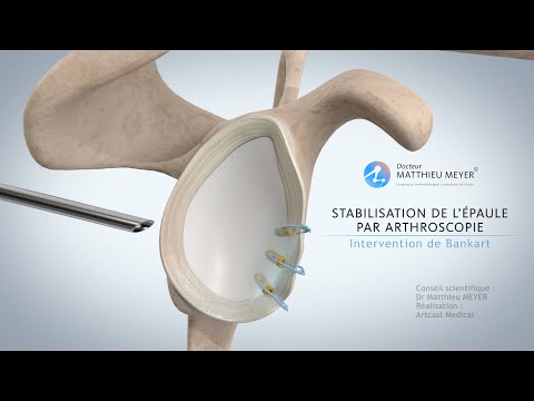 Vidéo: Les déchirures du labrum glénoïdien guérissent-elles ?